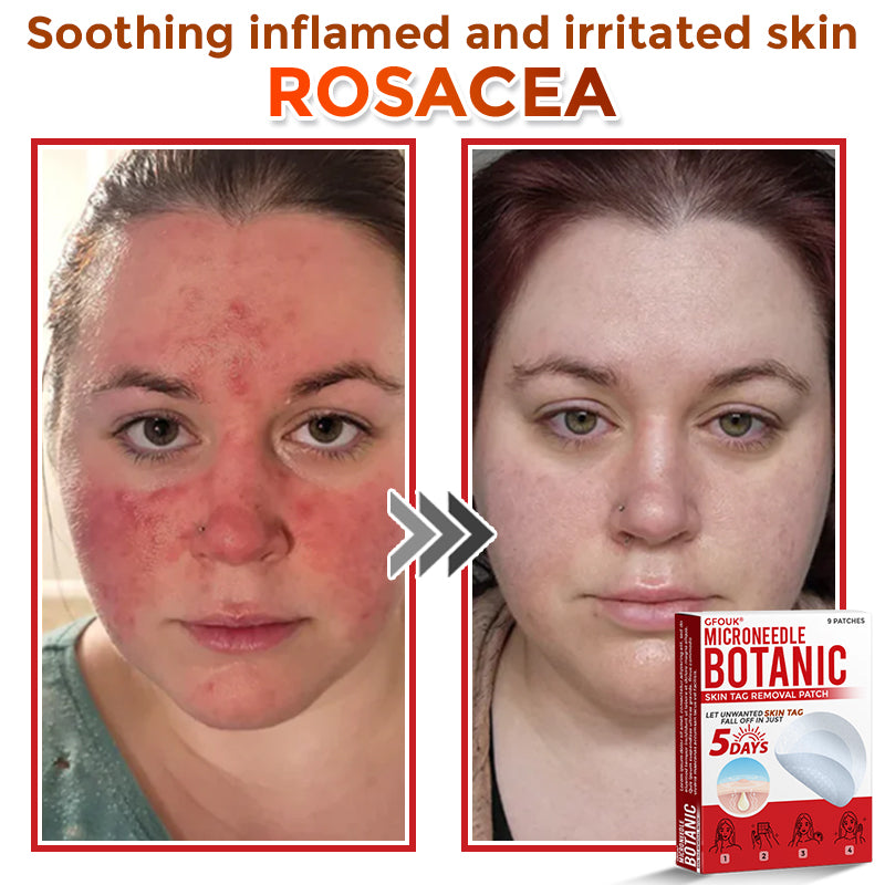 SkinTag™ – Lässt Hautanhängsel mühelos verschwinden für glatte, makellose Haut [50% Rabatt]