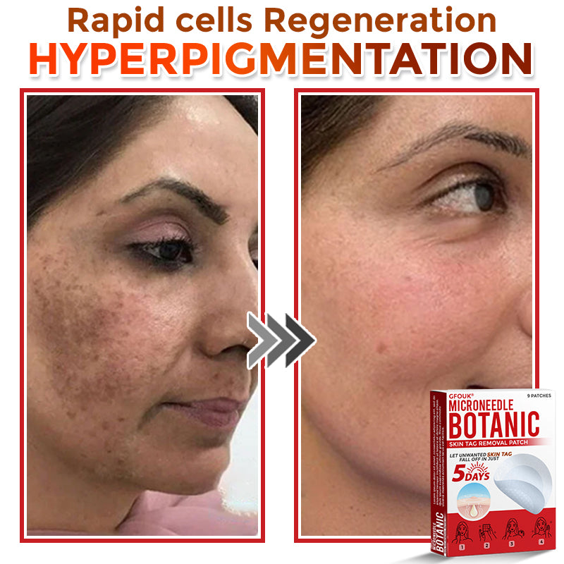 SkinTag™ – Lässt Hautanhängsel mühelos verschwinden für glatte, makellose Haut [50% Rabatt]